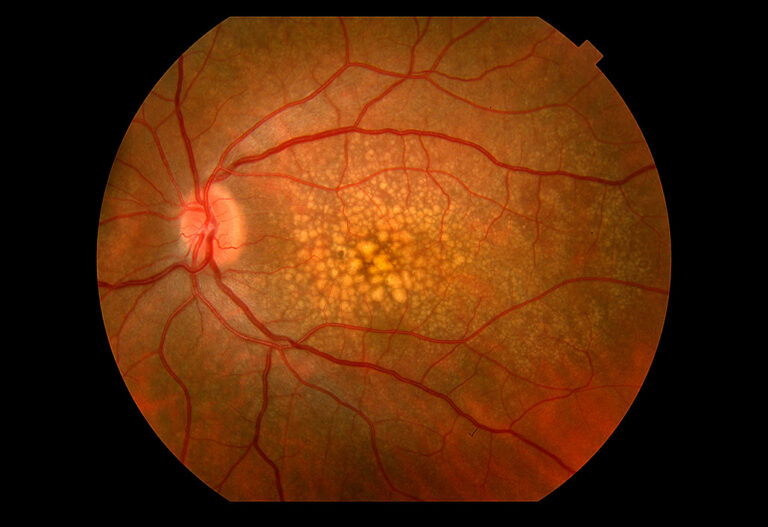 Macular Degeneration