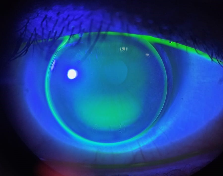 Gas Permeable (GP/RGP) Lenses